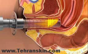 دستگاه لیزر دایود 1500،LASEmarR