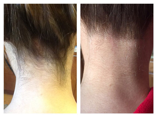 از بین بردن مو های زائد گردن زنان با لیزر