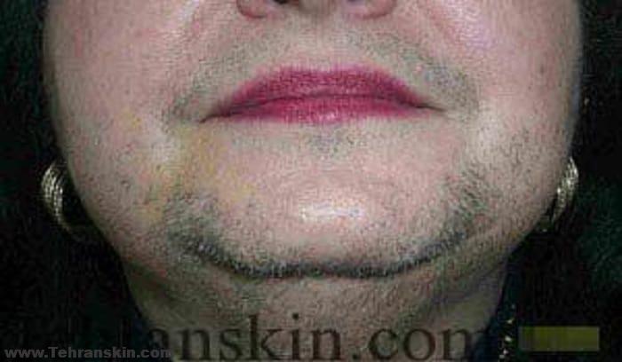 نادرست ترین شایعات در مورد لیزر