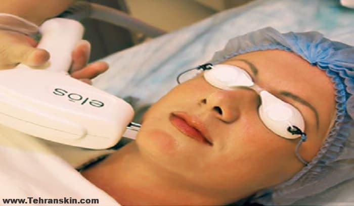 بهترین روش حذف موهای روشن