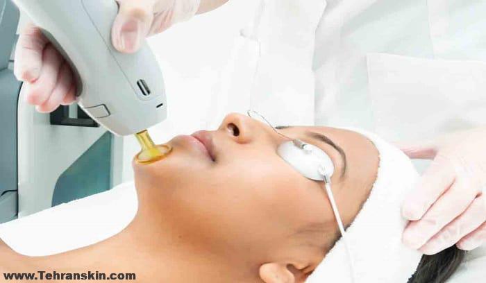 لیزر درمانی برای چروک