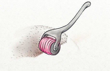 موثرترین و بهترین خدمات درمان ریزش مو: مزوتراپی. پی آر پی PRP. مزونیدلینگ