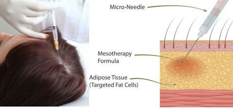 بهترین روش درمانی: مزوتراپی و ریزش مو: میکرونیدلینگ ترکیبی 