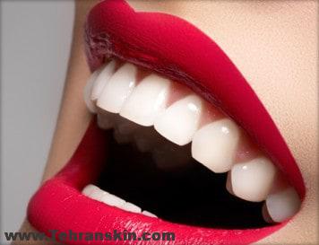 آیا تاثیر روش های سفید کردن دندان در همه افراد یکسان می باشد؟