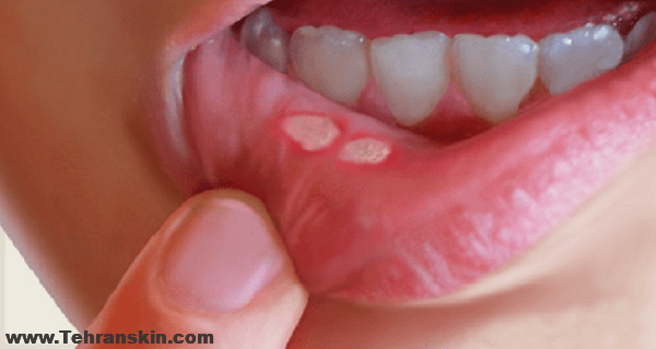 بهترین روش های درمان آفت دهان: 12 علت و 12 درمان