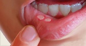 بهترین روش های درمان آفت دهان: 12 علت و 12 درمان