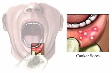 11 روش درمان آفت دهان