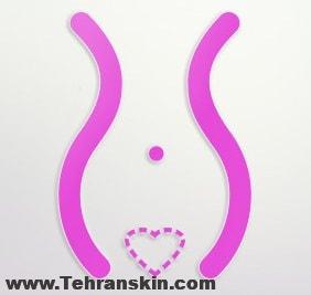 عمل جراحی لابیاپلاستی