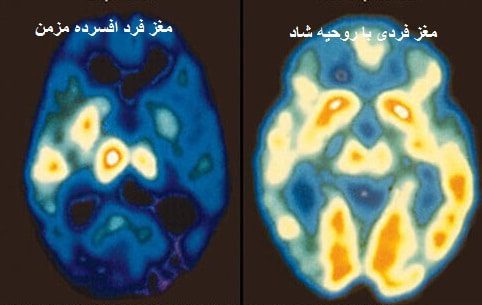 مقایسه مغز دو فرد افسرده و شاد
