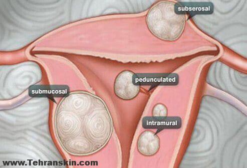 علائم فیبروم رحم یا فیبروئید