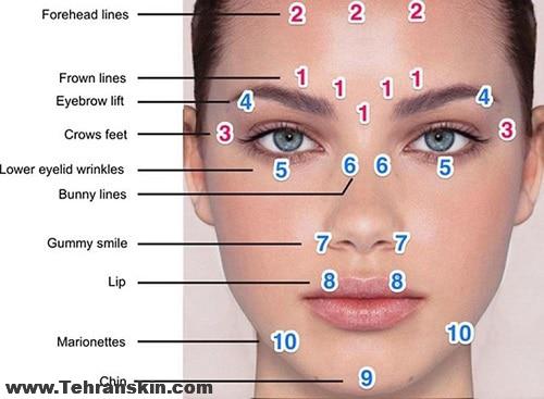 بهترین و مرغوب ترین ژل ها و فیلرها تزریق ژل لب گونه خط خنده چانه خط اخم