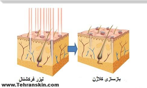 بهترین و موثرتریت درمان برطرف کردن جای جوش/ آکنه- لیزر فرکشنال CO2