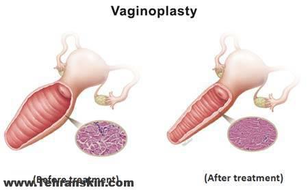 جراحی زیبایی واژن یا واژینوپلاستی