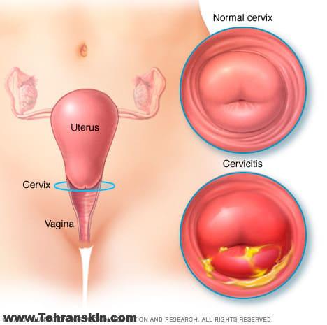 زخم دهانه رحم یا سرویسیت، علائم، علل و درمان آن