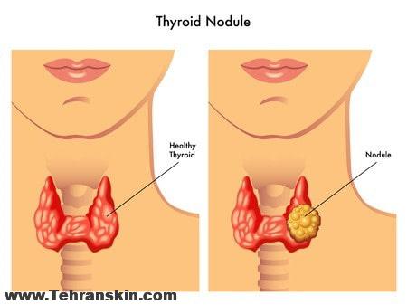 درمان ندول تیروئید (گره تیروئید)