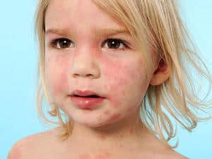 ستیریزین، بهترین دارو برای درمان واکنش های آلرژیک و کهیر hives in children - ستیریزین، بهترین دارو برای درمان واکنش های آلرژیک و کهیر