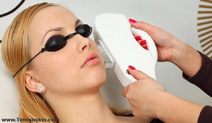 مهمترین نکات لیزر موها