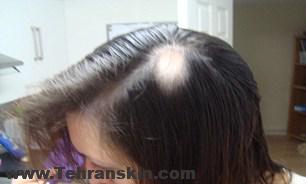 مهمترین علل ریزش مو