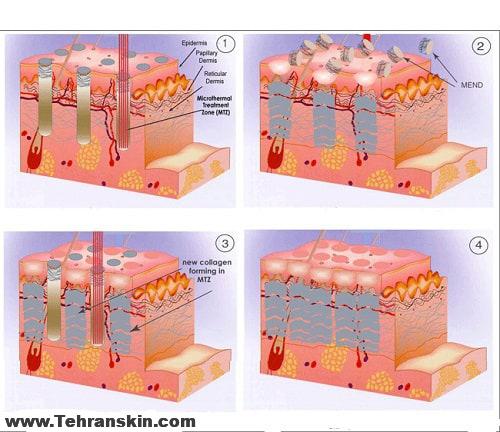 رفع سوختگی با لیزر فرکشنال CO2 در بهترین مرکز سپهر