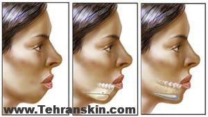 تزریق چربی :سینه و صورتی خوش فرم تنها در چد دقیقه