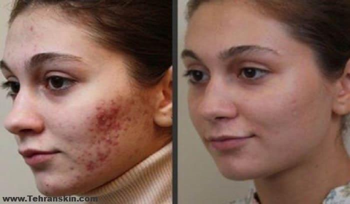 بهترین گیاه ضد جوش