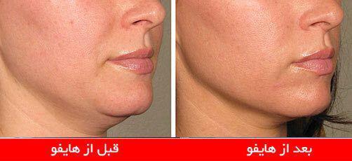 بهترین مرکز هایفوتراپی