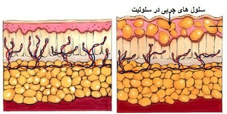 سلولیت و بهترین دستگاه های لاغری