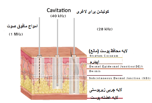 لاغری با کوتیشن مافوق صوت