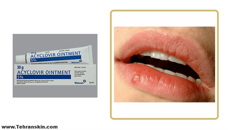 درمان تبخال با آسیکلوویر