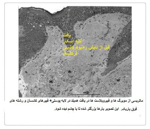 بافت آکنه اسکار قبل از آر.اف.فرکشنال