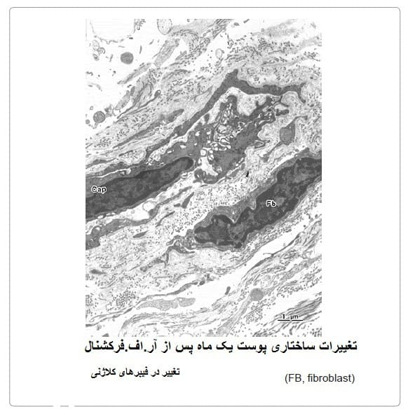 بهترین کلینیک زیبایی: یک ماه پس از آر.اف.فرکشنال