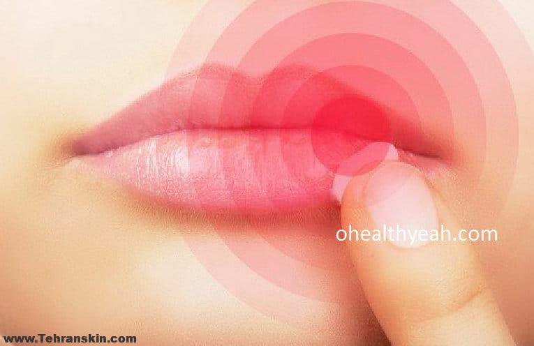 ویروس هرپس سیمپلکس