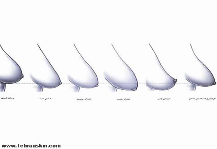  سینه های خوش فرم وسفت با ماموپلاستی کاهنده یا جراحی کوچک کردن سینه 