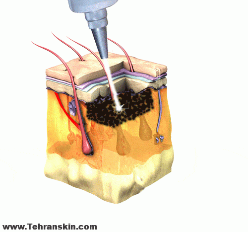 برداشتن تاتو خالکوبی با لیزر کیوسوییچ