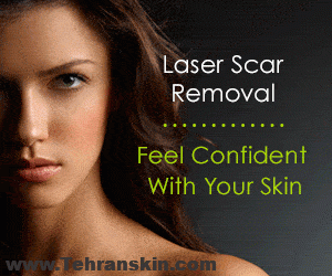 لیزردرمانی آکنه