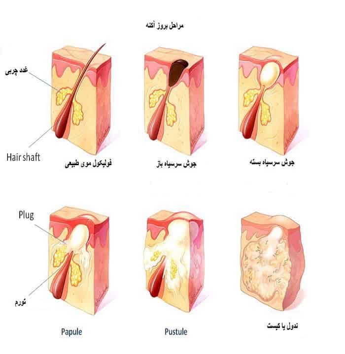 لیزردرمانی آکنه معرفی بهترین مرکز لیزر فرکشنال