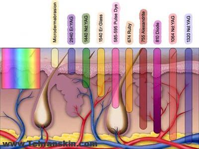 لیزر موهای زائد آپوجی پلاس