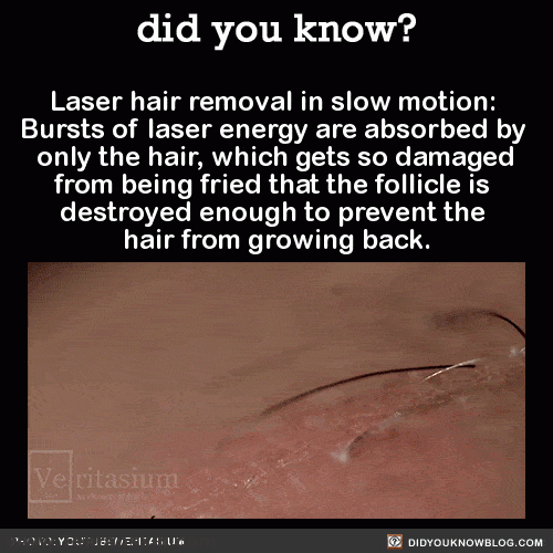 لیزر موهای زائد آپوجی پلاس