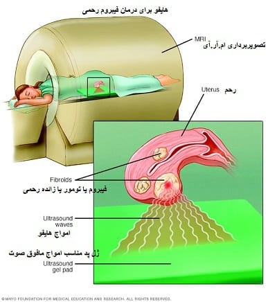 درمان تومور یا فیبروم رحمی با هایفو