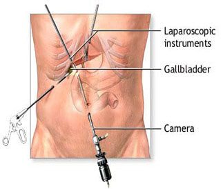 لاپاروسکوپی