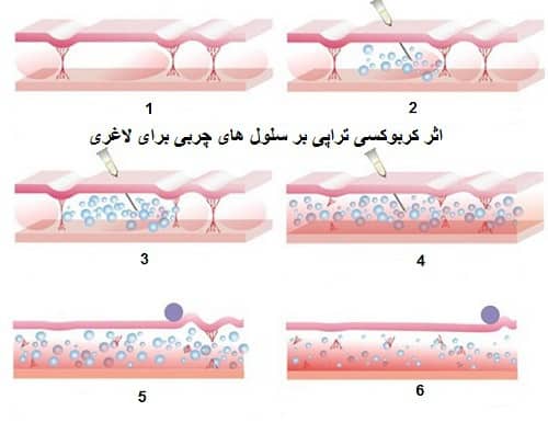 لاغری و درمان سلولیت با کربوکسی تراپی