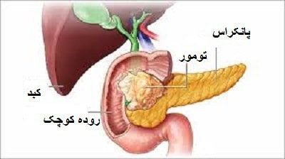 سرطان پانکراس و ابتلای گلو به ویروس پاپیلوما انسانی