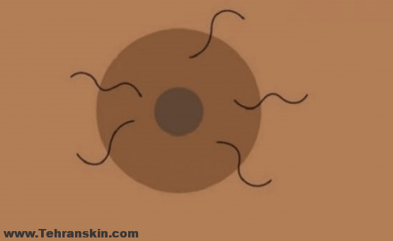 لیزر موهای زائد نوک سینه