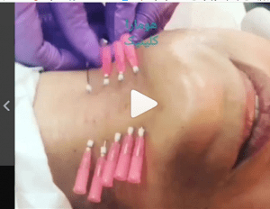 نخ PDO برای لیفت صورت ابروان و رفع خطوط خالی