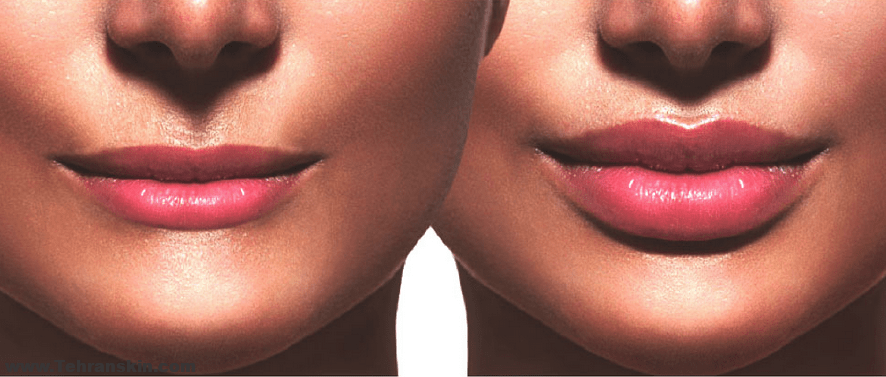 پر شدن و بزرگ تر شدن لب ها