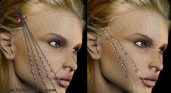 لیفت باسن و صورت با ژل-چربی-نخ در کلینیک تخصصی هومارا