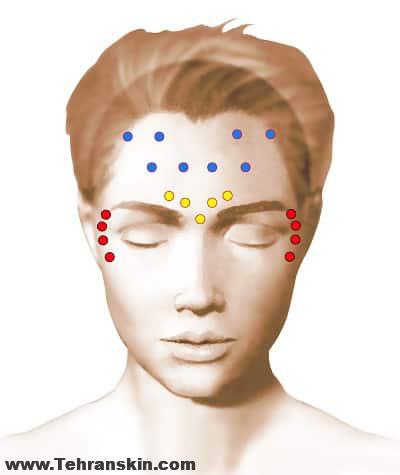 بهترین مرکز تزریق بوتاکس در تهران (در ترکیب با ژل)