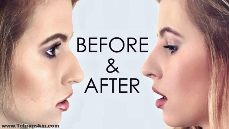 تزریق ژل به بینی