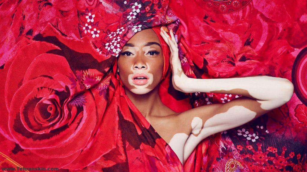 ویتیلیگو ( پیسی/برص)