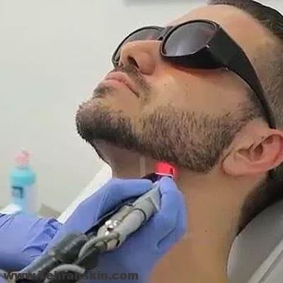 قبل از لیزر درمانی از مصرف آنتی بیوتیک ها اجتناب کنید